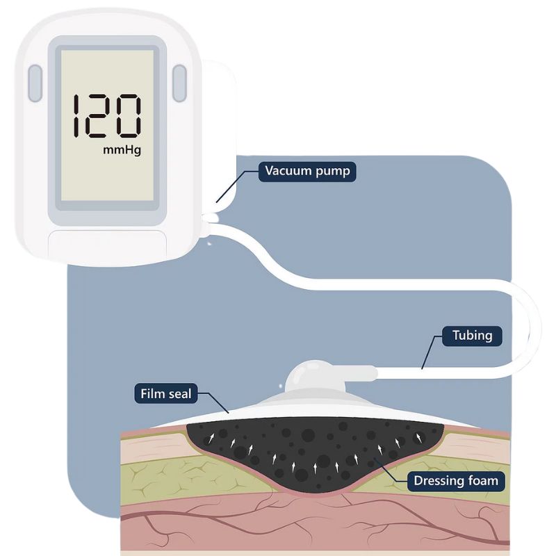 negative pressure wound therapy infographic